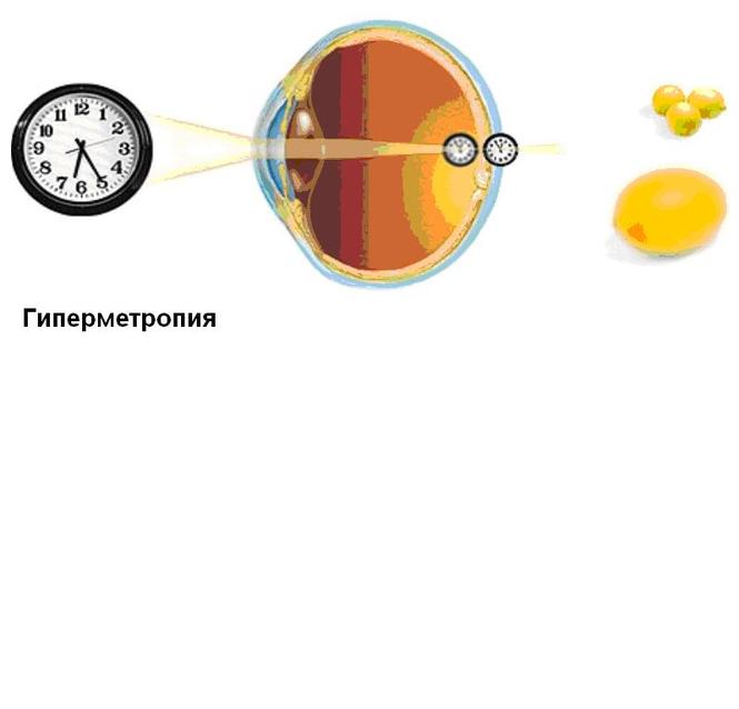 Гиперметропия средней степени глаза